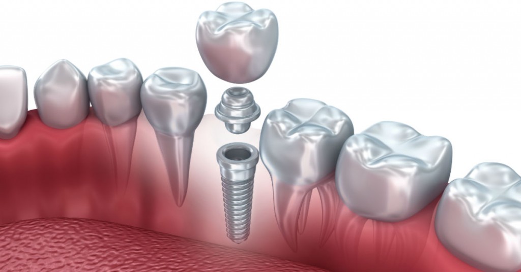 Why Do I Need A Dental Implant?