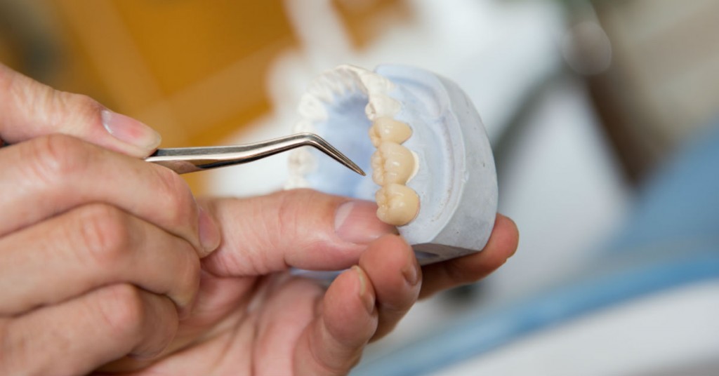 Costly Replacements: The Benefits of Replacing Your Implant Or Bridge