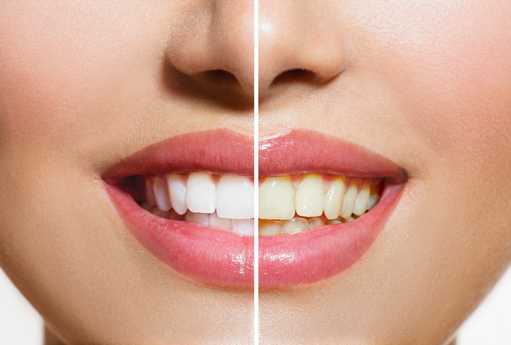How Do You Maintain White Teeth? Dr. Rebecca Rath DMD Billings Dentist