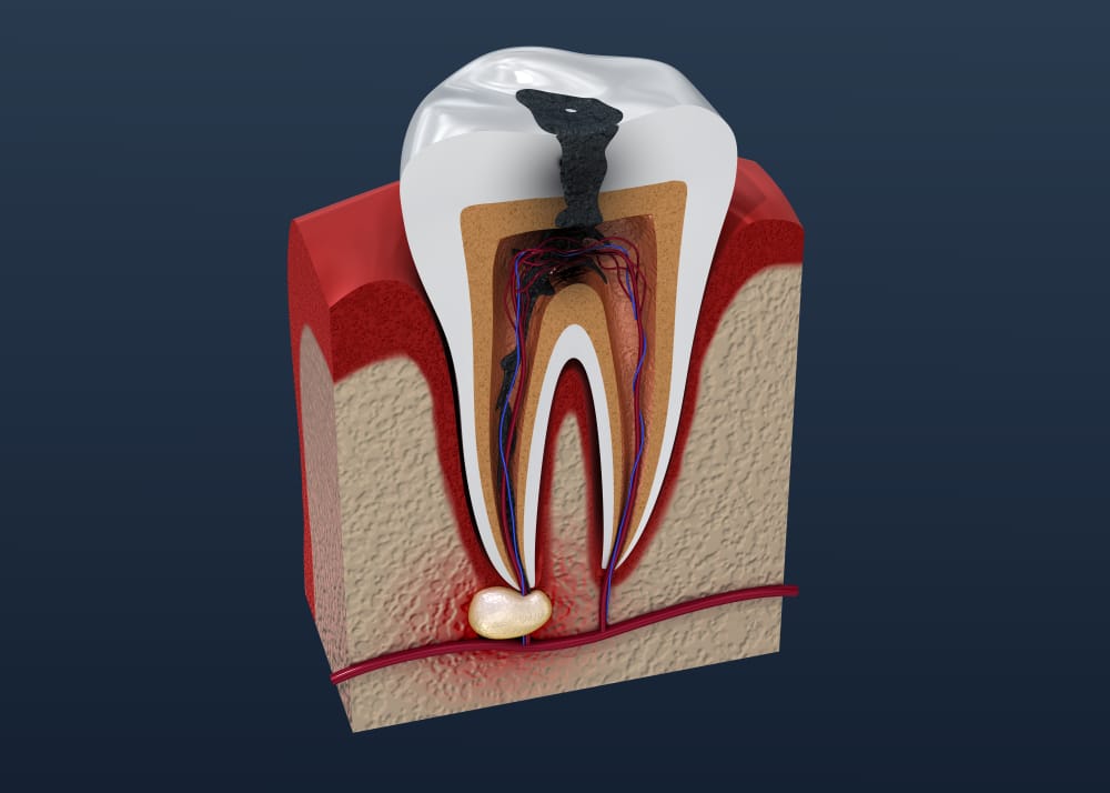 How Do Dentists Treat A Tooth Abscess?