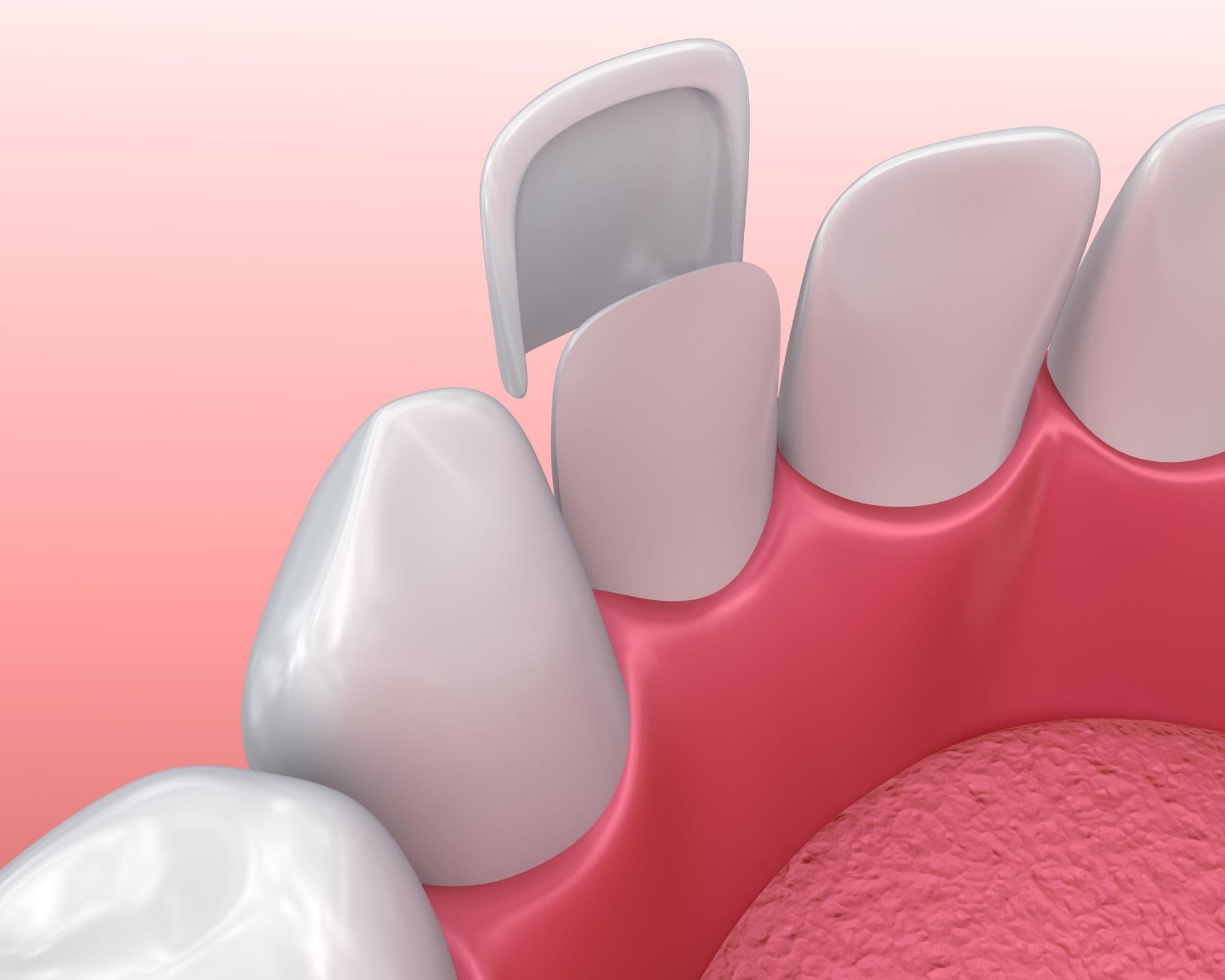 Pros and Cons of Dental Veneers Dr. Rebecca Rath DMD Billings Dentist