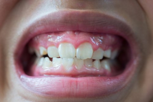 what is dental erosion