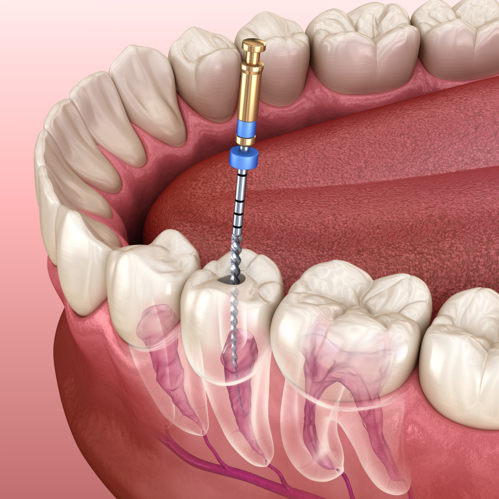 root canal dental implant