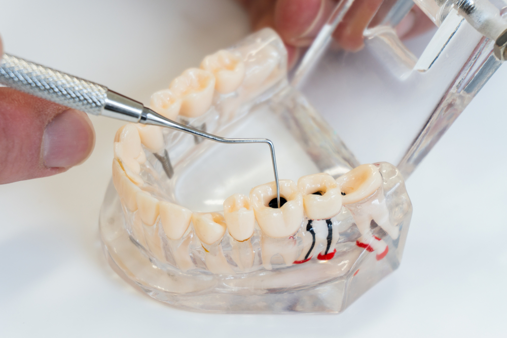 Why Do My Root Canalled Teeth Still Hurt?